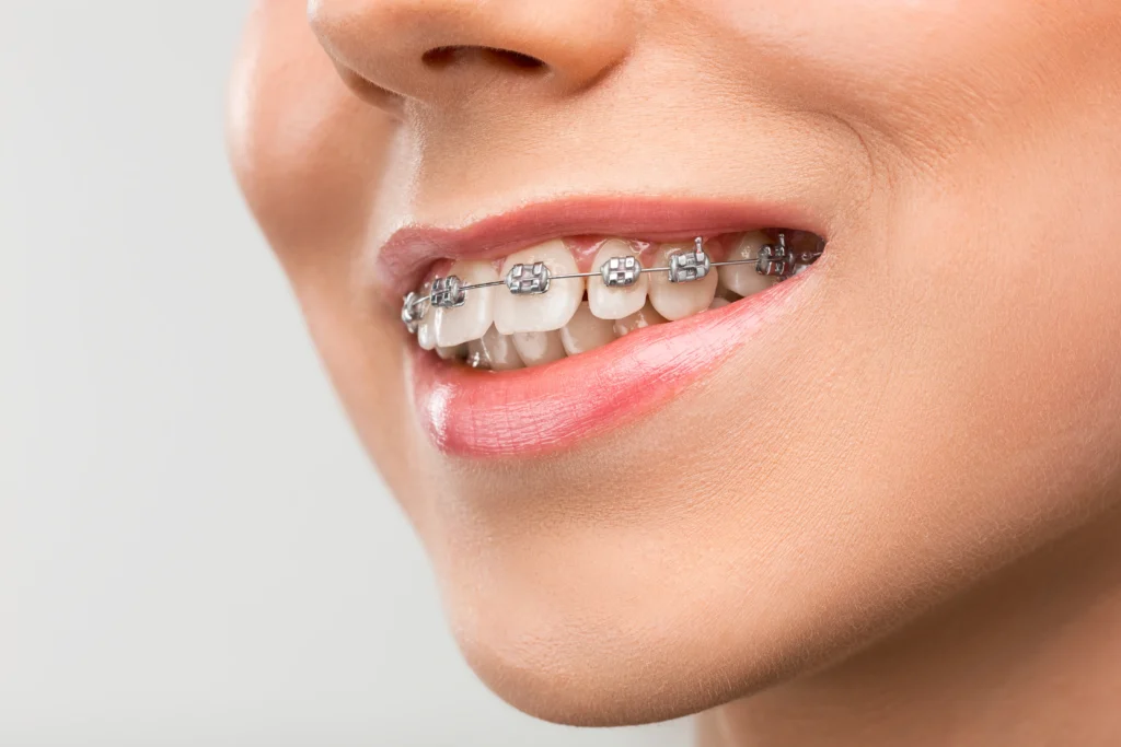 Braces Treatment in Pimpri Chinchwad Dr Lokhande Dental Clinic